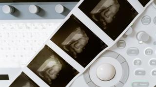 Father's Role Highlighted in Decisions on Prenatal Diagnoses