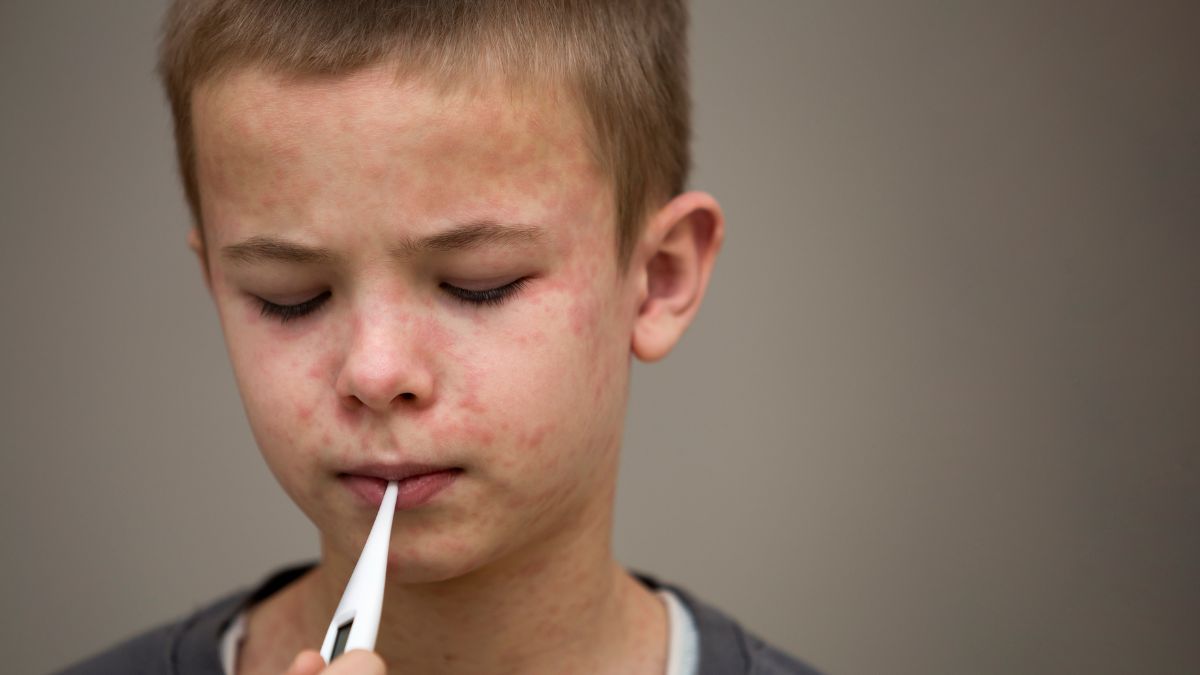 Media's Fearmongering Foiled As TX Measles Outbreak Ends